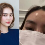 Ninh Dương Lan Ngọc đăng ảnh trán chi chít mụn