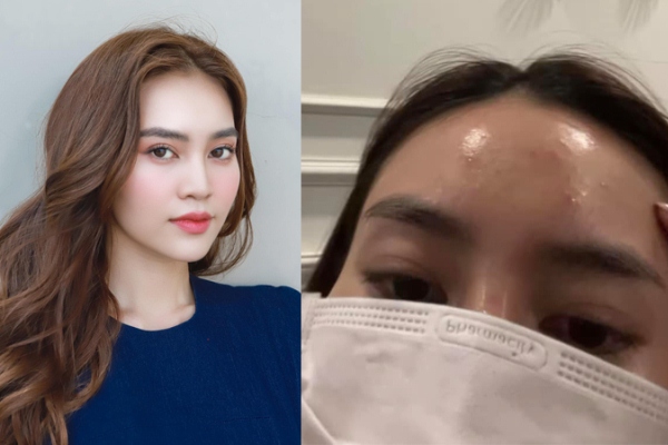 Ninh Dương Lan Ngọc đăng ảnh trán chi chít mụn